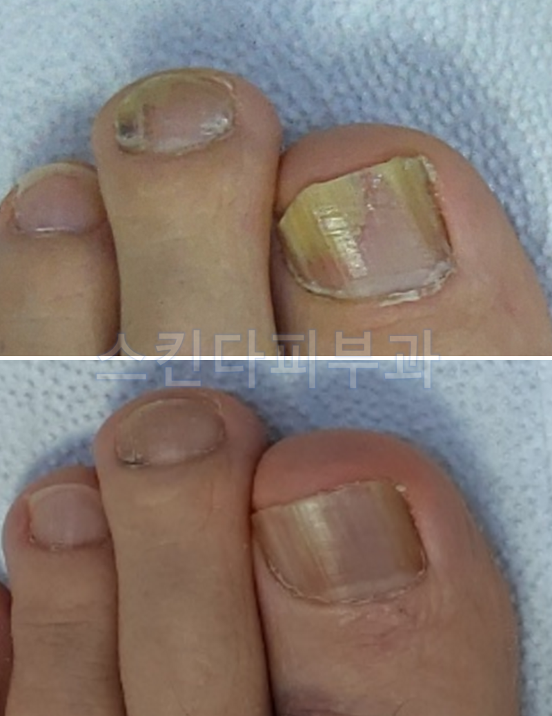 손톱무좀 손톱무좀 밑에는 손톱레이저를 추천합니다.