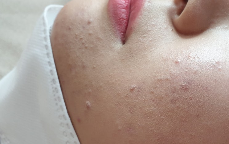  테스토스테론(testosterone)과 여드름(acne), 다낭성 난소 증후군 - 호르몬 불균형