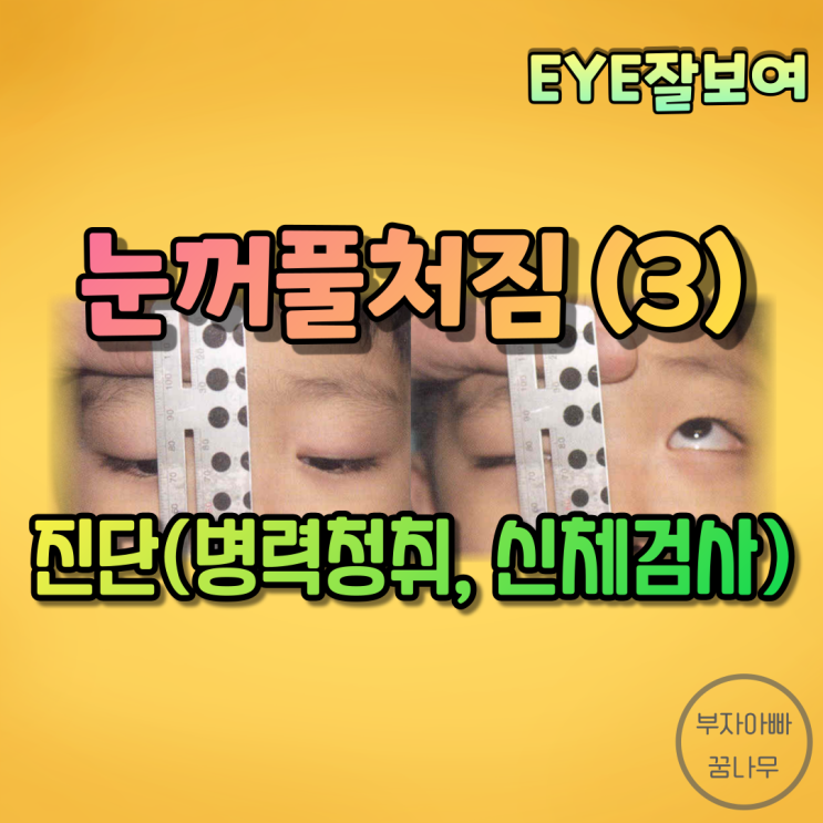 [EYE잘보여] 눈꺼풀처짐(안검하수, Blepharoptosis, Ptosis) (3) - 진단(병력청취, MRD, LFT, 쌍꺼풀 확인, 호르너증후군 감별, 헤링의 법칙 확인)