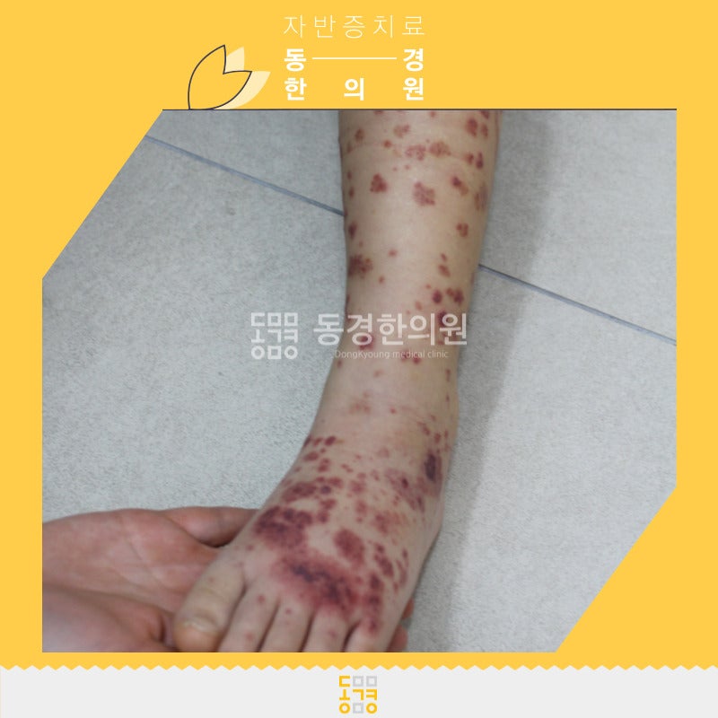 HS자반증 어떤 증상을 보일까요?
