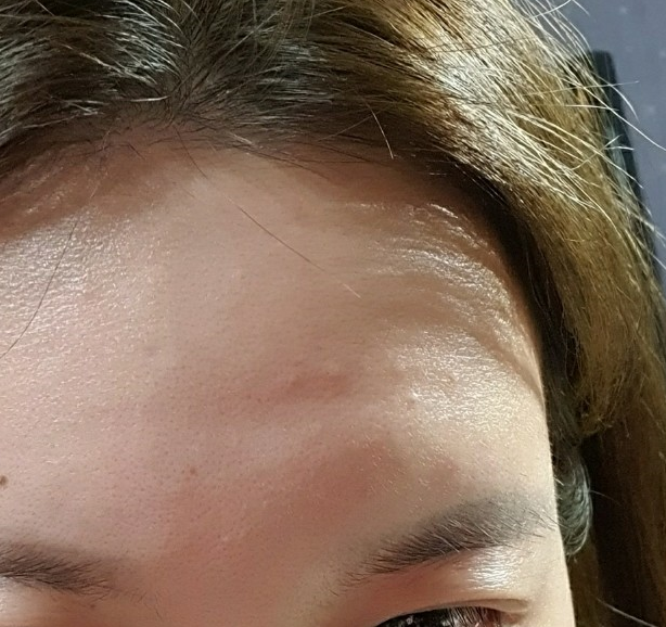 이마 필러 부작용, 시술 시 꼭 고려해야 할 사항은? 이마 필러 부작용, 시술 시 꼭 고려해야 할 사항은?