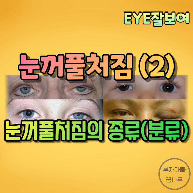 [EYE잘보여] 눈꺼풀처짐(안검하수, Blepharoptosis, Ptosis) (2) - 분류: 널힘줄성 · 근성 · 신경성 · 외상성 · 가성(거짓) 눈꺼풀처짐