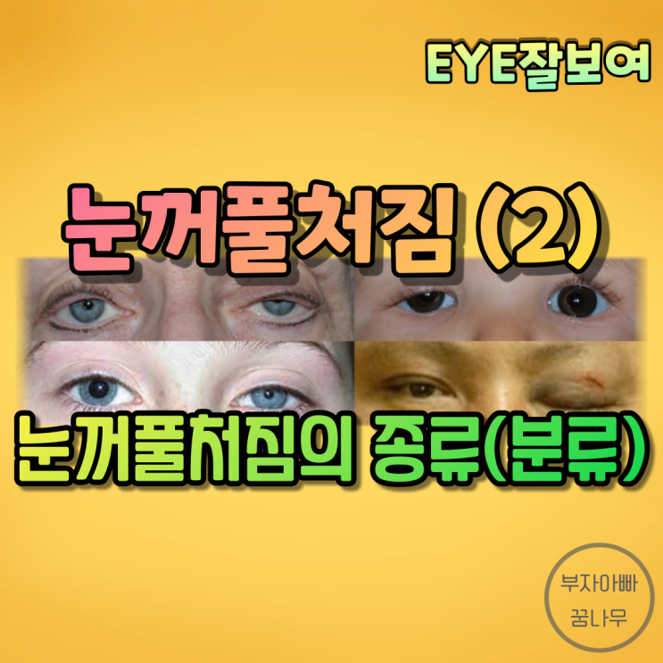  [EYE잘보여] 눈꺼풀처짐(안검하수, Blepharoptosis, Ptosis) (2) - 분류: 널힘줄성 · 근성 · 신경성 · 외상성 · 가성(거짓) 눈꺼풀처짐