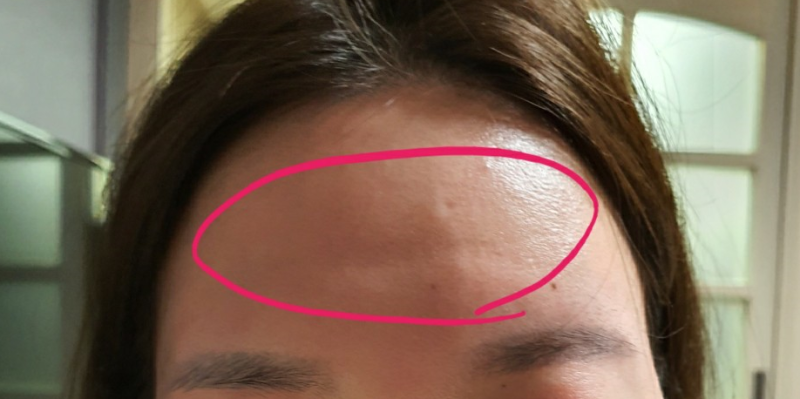 이마 필러 부작용, 시술 시 꼭 고려해야 할 사항은? 2