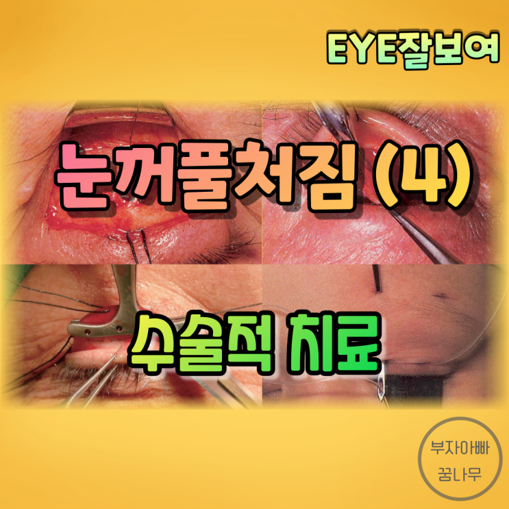 [EYE잘보여] 눈꺼풀처짐(안검하수, Blepharoptosis, Ptosis) (4) - 수술: 눈꺼풀올림근널힘줄 교정술, 결막뮐러근절제술, 이마근걸기술 등