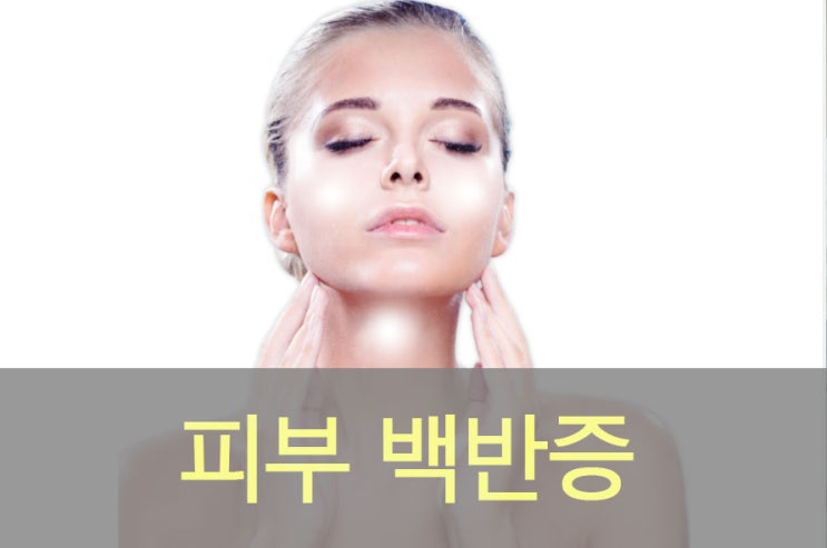  피부 백반증 원인과 증상, 좋은 음식, 영양제, 치료법