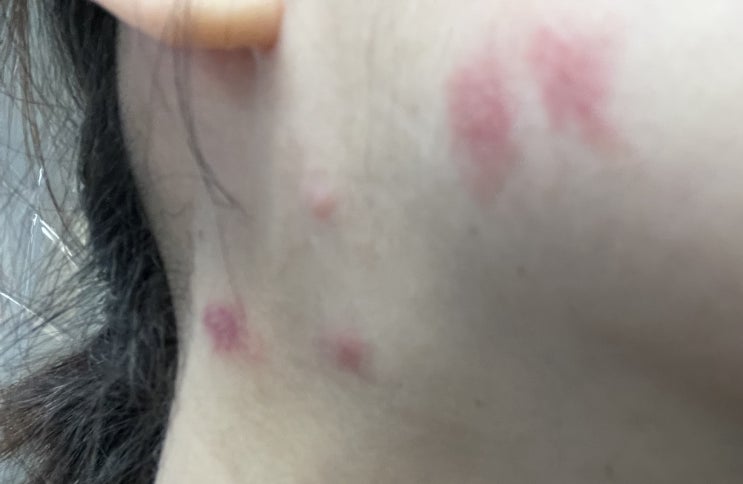  해외입국후 병원진료/자가격리면제자 일반병원 진료/피부과/ 피부미용이 아닌 진짜진료