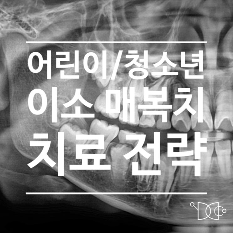 어린이 / 청소년 이소 매복치 교정, 언제 & 어떻게 해야할까? 치료 전략세우기