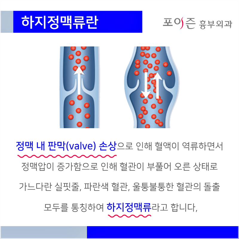 간단한 스트레칭으로 하지정맥류의 초기 증상을 관리하여 예방합니다. 7