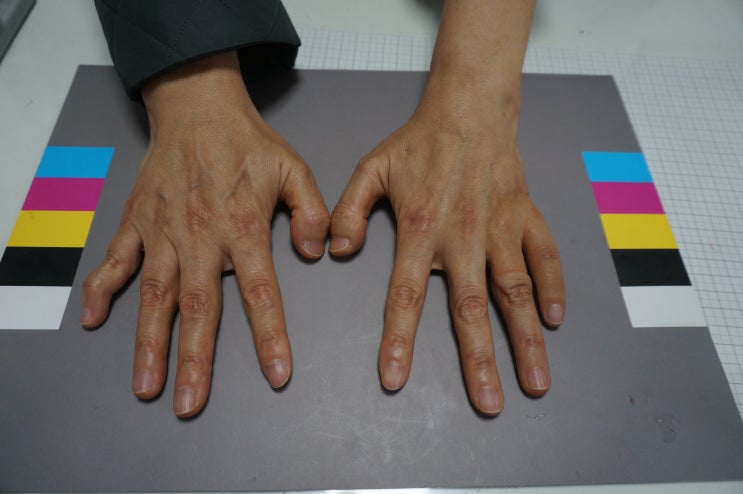  남은 마디가 짧은 손가락에 맞춤 실리콘 손가락으로 제작하세요.