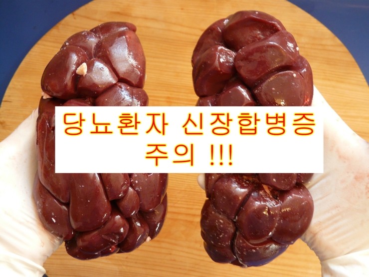 [당뇨병]당뇨환자, 소리없이 다가오는 신장합병증 주의!!!