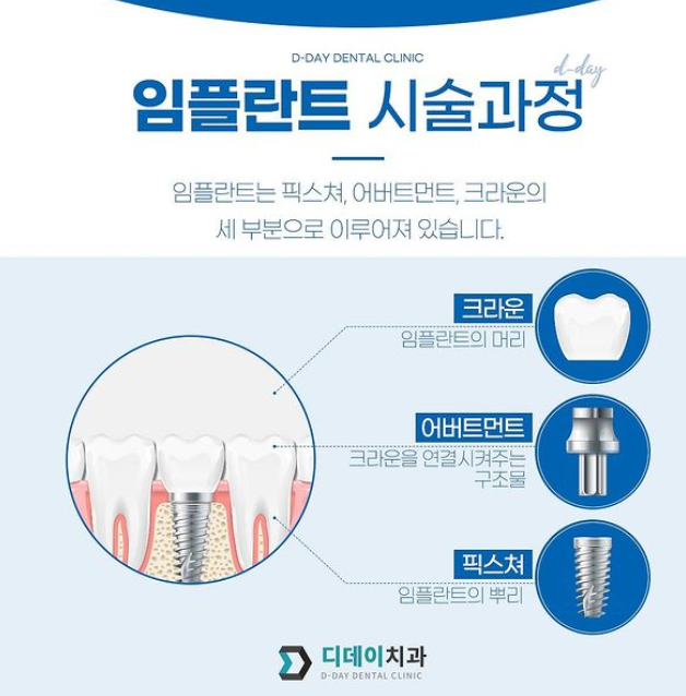 덴티움 임플란트 가격? 전문의가 폭로합니다. : 네이버 블로그 덴티움 임플란트 가격? 전문의가 폭로합니다. : 네이버 블로그