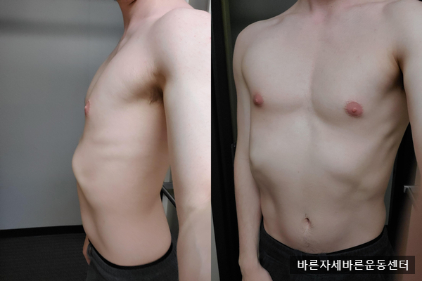  [늑골돌출] 갈비뼈가 튀어나와 보인다면..?