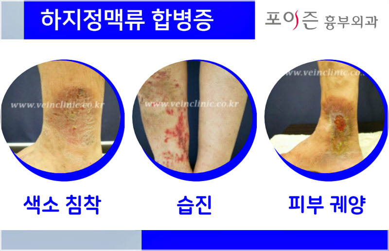 간단한 스트레칭으로 하지정맥류의 초기 증상을 관리하여 예방합니다. 11
