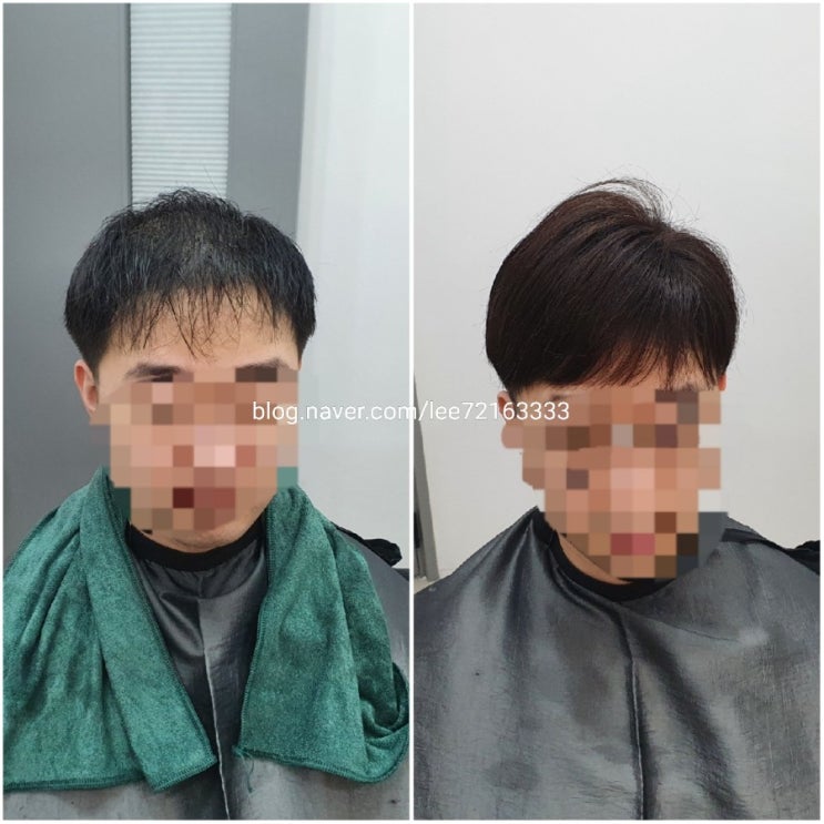  망도 틀도 없이 3만모를 한방에 늘려준다고요? 보톡스증모술은 가능하죠!