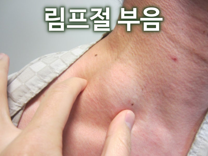 목 멍울, 림프절에 혹이 만져지는 경우, 암일 가능성은? 병원에 가야 하는 증상과 시기 - 림프....