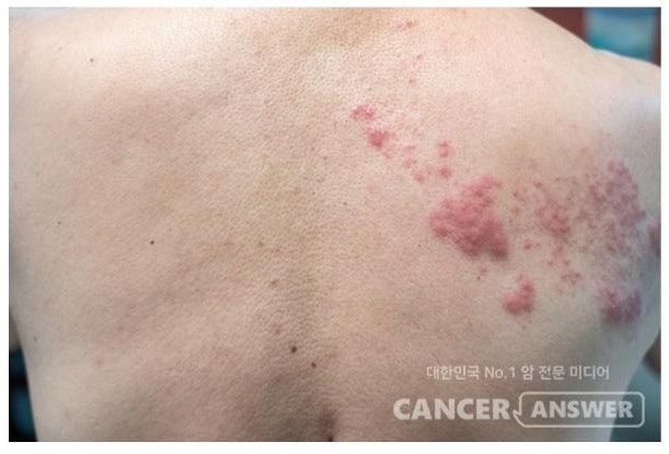 독산정형외과 대상포진 초기증상 감기 걸렸다고 생각하면 4