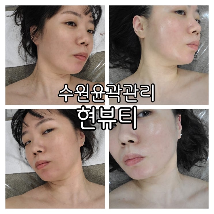 수원윤곽관리 현뷰티 써마프락과 하이푸리프팅까지 젊어진 하루