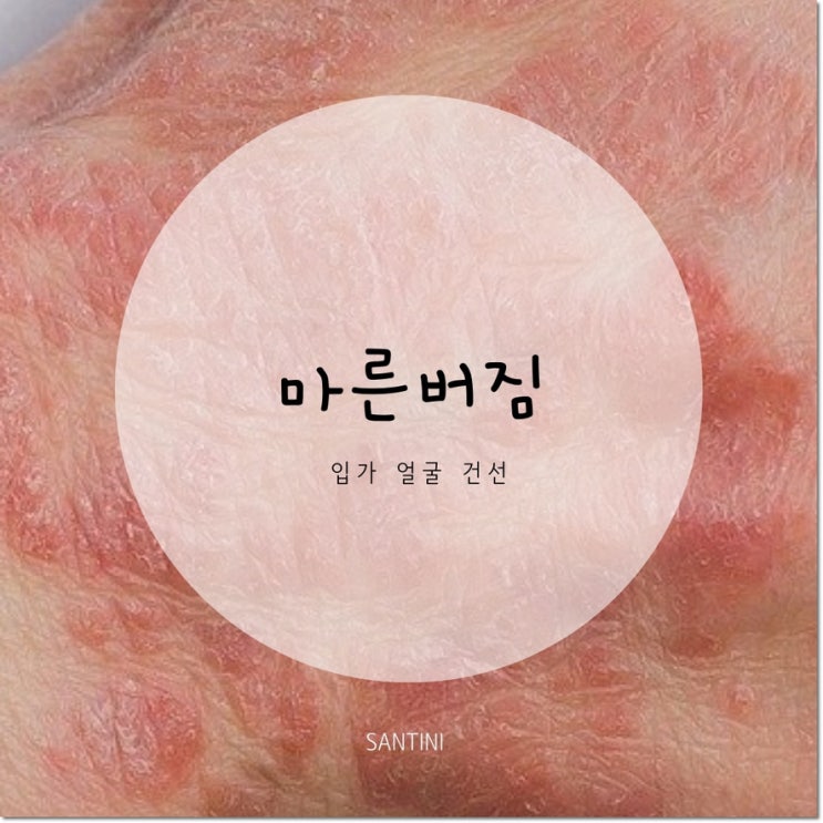 얼굴 입가 피부 마른버짐 원인 과 관리 얼굴 입가 피부 마른버짐 원인 과 관리