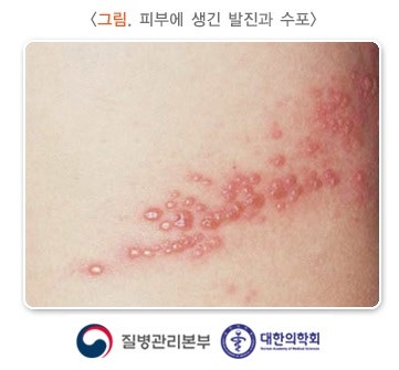 독산정형외과 대상포진 초기증상 감기 걸렸다고 생각하면 2