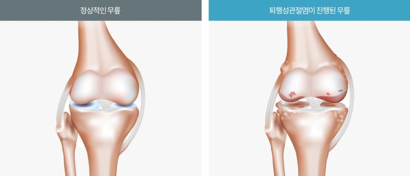 광진구 성형외과 시큰거리는 무릎 퇴행성 관절염 치료