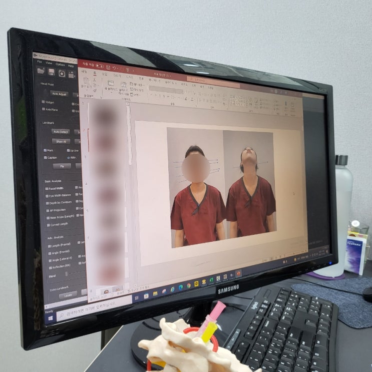  부산안면비대칭 1회만으로도 효과가 보여요