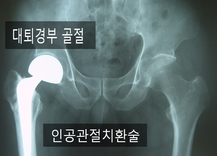 대퇴골 경부골절 사례