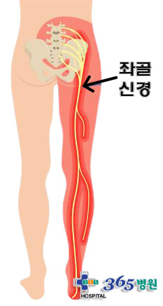 [창원마산 척추관절 디스크 365병원] 좌골신경통