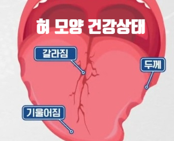  혀 모양으로 보는 건강상태 확인법 (ft. 갈라짐 기울어짐 울퉁불퉁 두꺼운 두께)