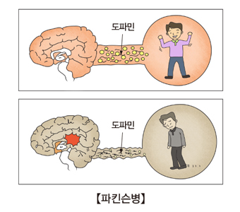  파킨슨병도 자가면역질환?