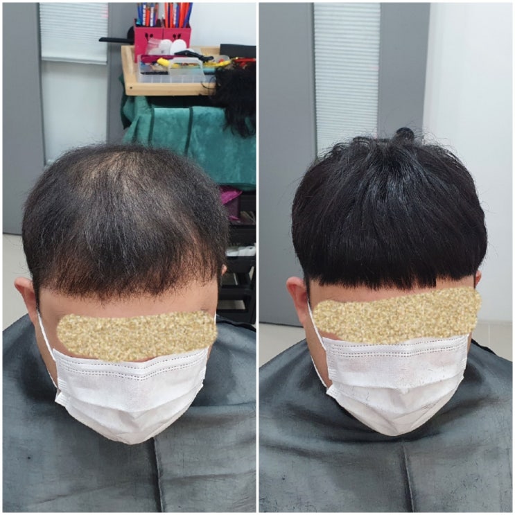  잘못된 보톡스증모술 그대로 있으실건가요? 춘천김호증모가발덕후