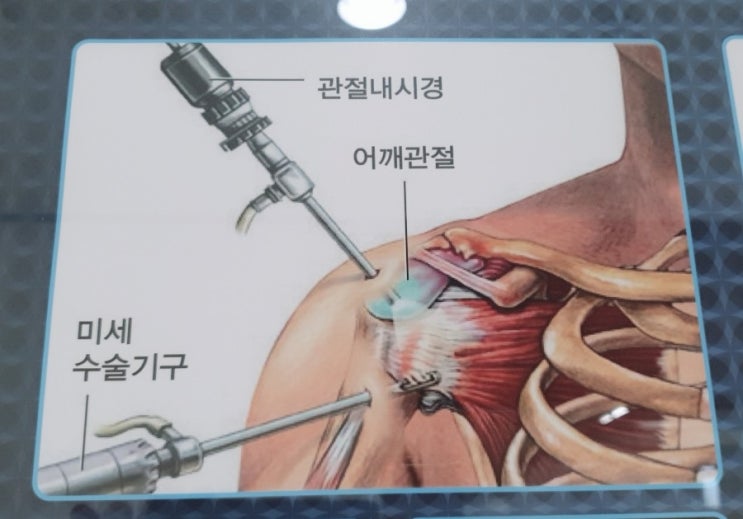  석회성건염 D+2