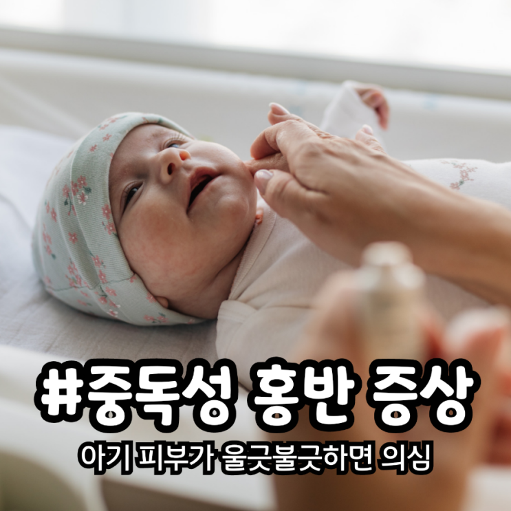  아기 피부가 울긋불긋 하면 중독성 홍반 증상 의심