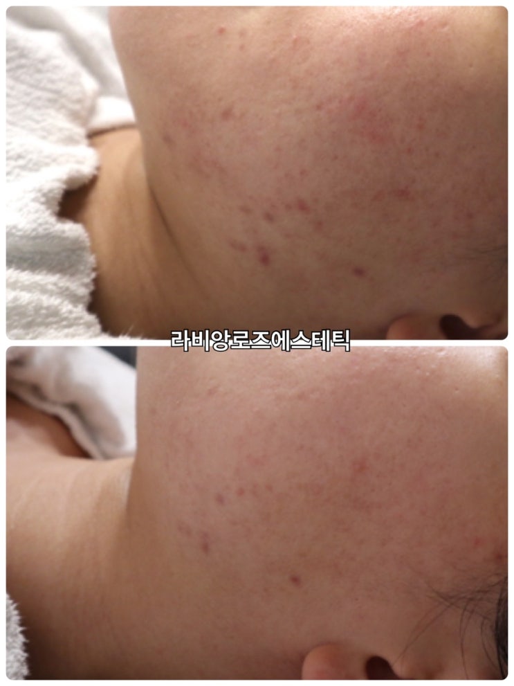  청량리피부관리 갑자기 올라온 붉은여드름 어떻게 없앨까?