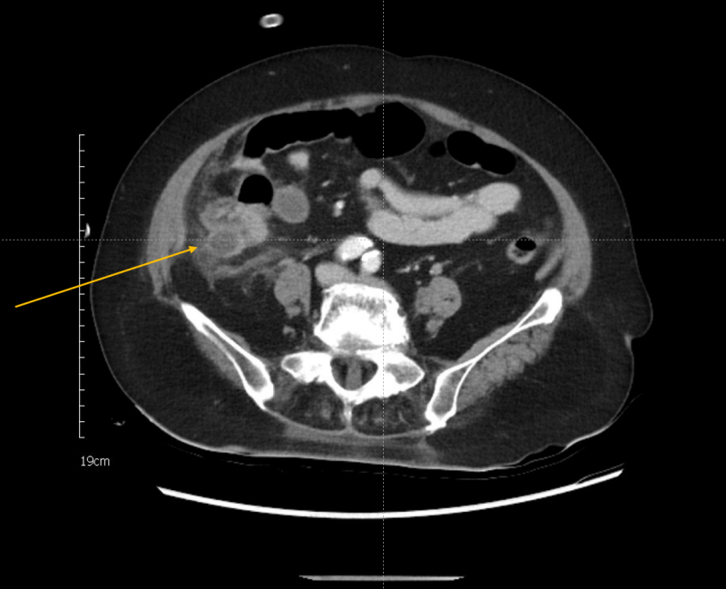 [영상의학과] 복부 케이스_Appendicitis, Appendiceal mucocele : 네이버 블로그