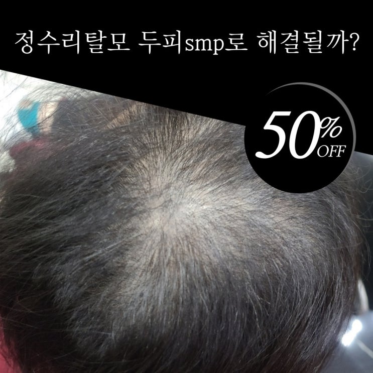 창원 두피smp 정수리 탈모 커버 관리받으면 좋은 점