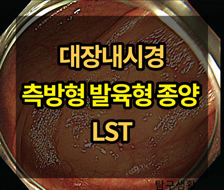  대장내시경 측방발육형 종양 Lateral spreading tumor, LST