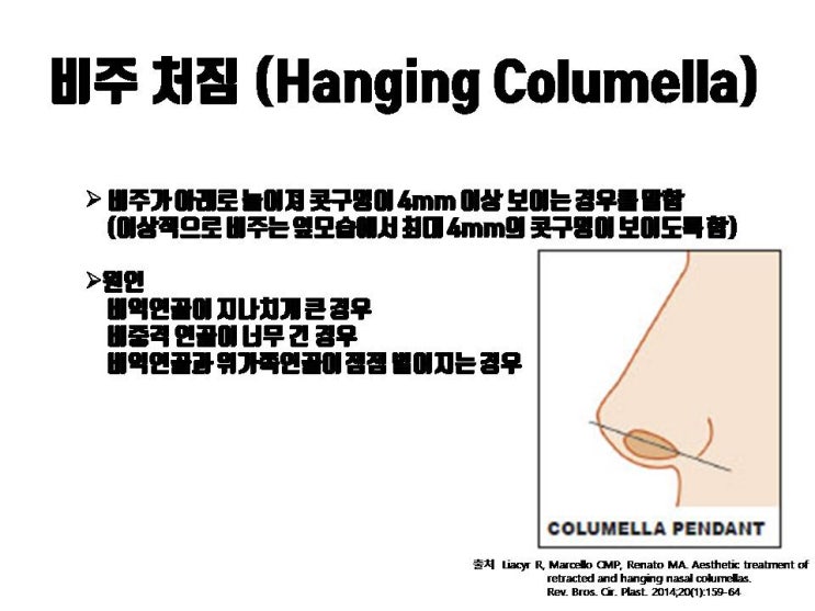  비주(코기둥)가 처져 있는 경우 비주올리기로 교정하세요!!!