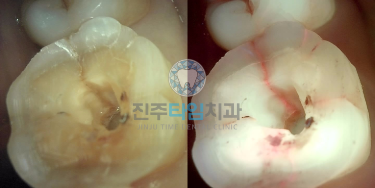  큐레이로 본 치아, 크랙