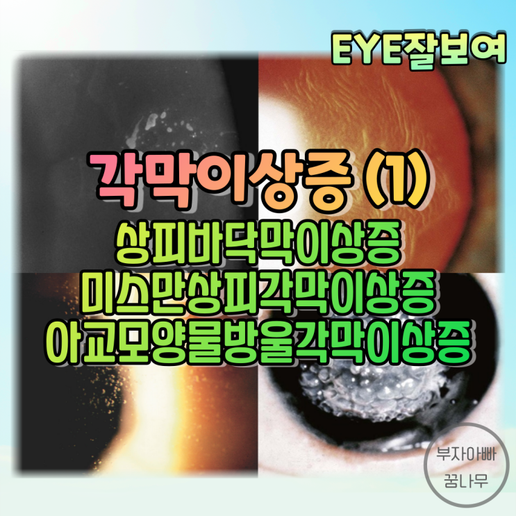  [EYE잘보여] 각막이상증(Corneal Dystrophies) (1) - 상피 & 상피하 각막이상증: 상피바닥막이상증, 미스만상피각막이상증, 아교모양물방울각막이상증