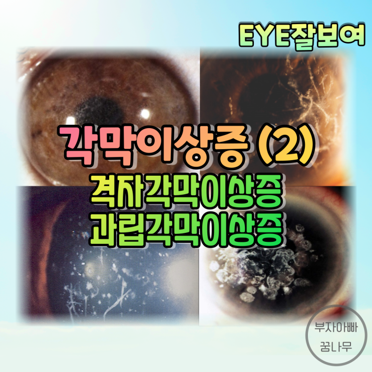 [EYE잘보여] 각막이상증(Corneal Dystrophies) (2) - 상피 & 기질 이상증(TGFBI 관련): Reis-Bucklers, Thiel-Behnke, 격자, 과립