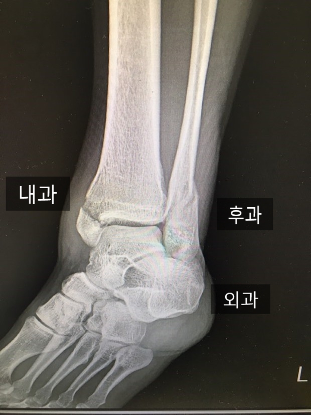  발목 삼과골절 (족관절 삼과골절)사례