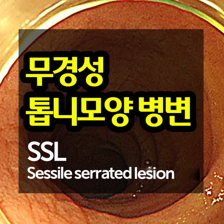 대장의 무경성 톱니모양 병변(Sessile serrated lesion)