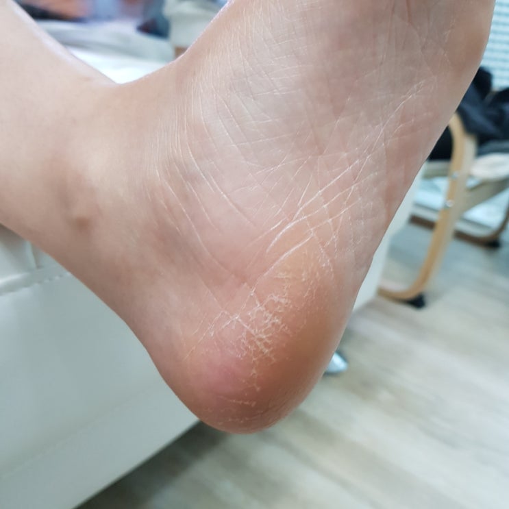  메이크페이스 후크발각질제거기 솔직사용후기 >> 전동발각질제거기, 발뒤꿈치각질제거기 추천!