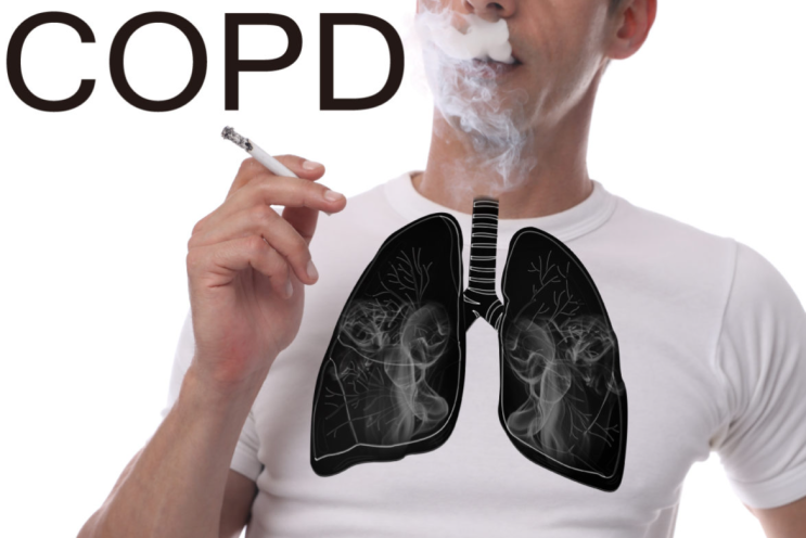  폐기종,만성폐쇄성폐질환(COPD) 호흡곤란 치료와 효과 빠른 보조제
