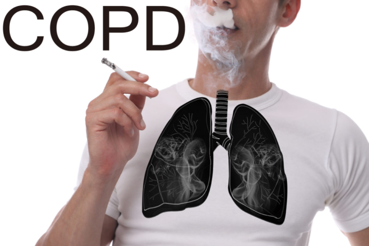 폐기종,만성폐쇄성폐질환(COPD) 호흡곤란 치료와 효과 빠른 보조제