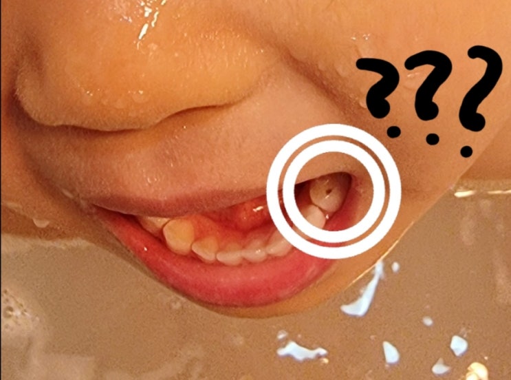  김포온어린이치과_4살아이 치아에 구멍이?!