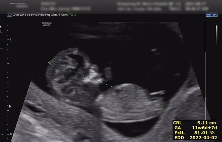 [임신 11주, 15주] 1,2차 기형아 검사(염색체이상 위험도 검사) : 은평성모병원