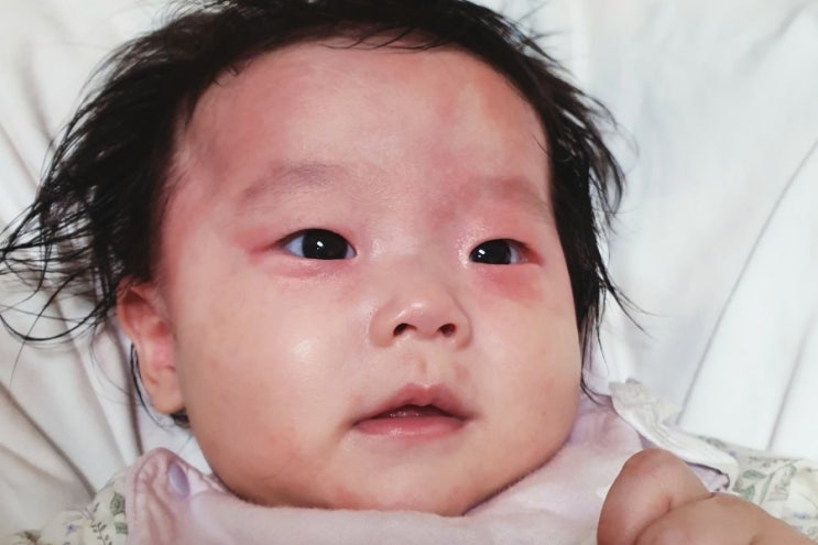  [D+130] SNS 믿고 베이비로션 제발 사지 마세요. #알러지반응 응급실 간 후기