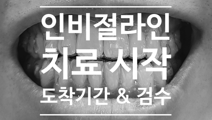재교정 일기) 인비절라인 치료 시작, 인비절라인 장치 도착 기간 & 장치 검수 / 연세꿈꾸는교정치과 재교정 일기) 인비절라인 치료 시작, 인비절라인 장치 도착 기간 & 장치 검수 / 연세꿈꾸는교정치과
